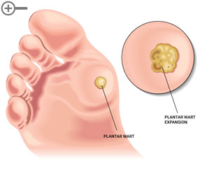 Plantar wart