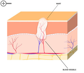 Wart Section