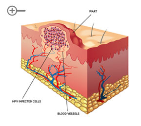 Wart-Section