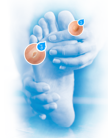piede-verrukill-il-trattamento