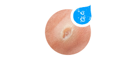 verruca1